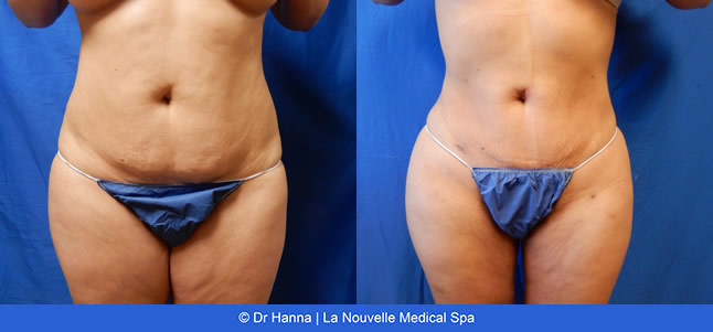 Liposuction, Smartlipo before after photos Ventura County, Dr. Hanna La Nouvelle Medical Spa, Oxnard
