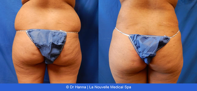 Liposuction, Smartlipo before after photos Ventura County, Dr. Hanna La Nouvelle Medical Spa, Oxnard