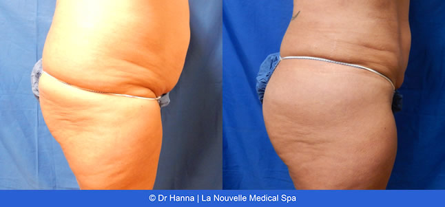 Liposuction, Smartlipo before after photos Ventura County, Dr. Hanna La Nouvelle Medical Spa, Oxnard
