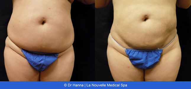 Liposuction, Smartlipo before after photos Ventura County, Dr. Hanna La Nouvelle Medical Spa, Oxnard