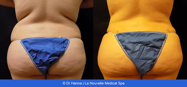 Liposuction, Smartlipo before after photos Ventura County, Dr. Hanna La Nouvelle Medical Spa, Oxnard