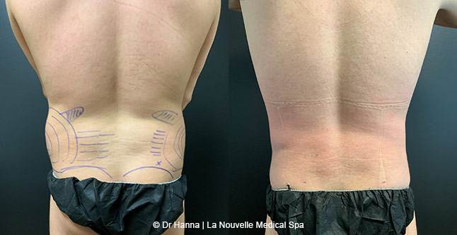 Liposuction, Smartlipo before after photos Ventura County, Dr. Hanna La Nouvelle Medical Spa, Oxnard