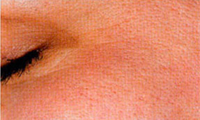 Microdermabrasion wrinkles after