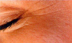 Microdermabrasion wrinkles  before