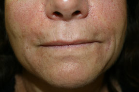 lip enhancement
