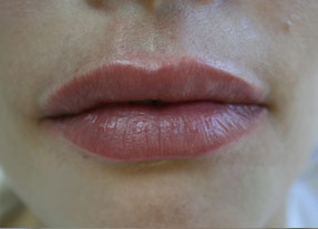 lip enhancement before and after with juvederm and volbella, oxnard