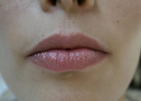 lip enhancement before and after with juvederm and volbella, oxnard