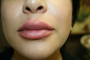lip enhancement before and after with juvederm and volbella, oxnard