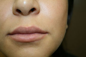lip enhancement before and after with juvederm and volbella, oxnard