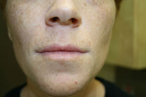 lip enhancementbefore and after