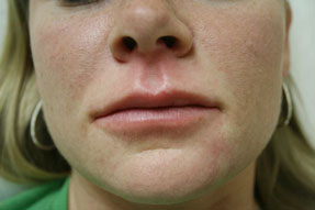 fillers, radiesse, juvederm, restylane before and after
