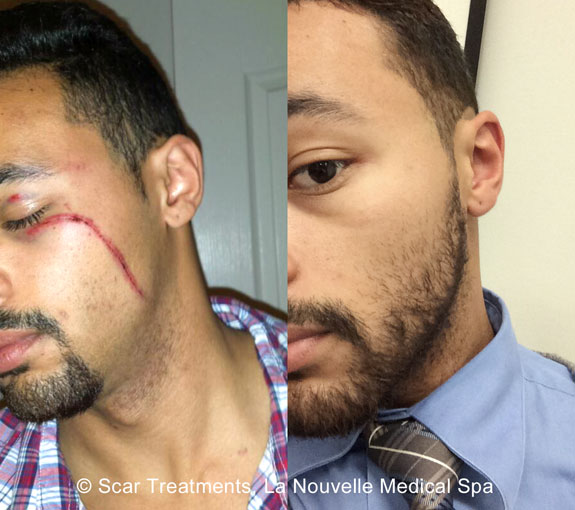 treating of scars before and after photos la nouvelle medical spa oxnard ventura