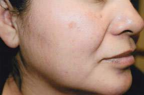 Sun & Age Spot - before