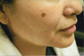 Sun & Age Spot - before