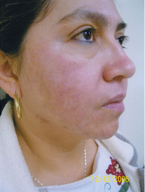 Sun & Age Spot - before