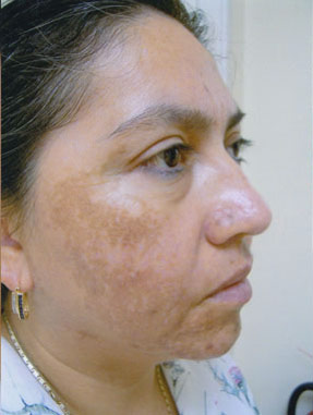 Sun & Age Spot - before