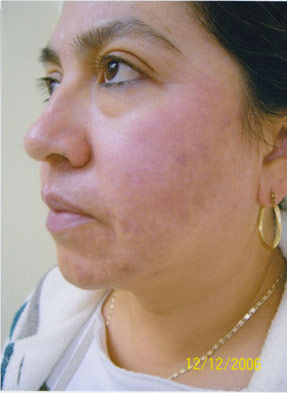 Sun & Age Spot - before