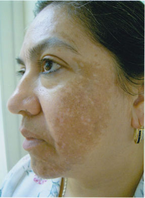 Sun & Age Spot - before
