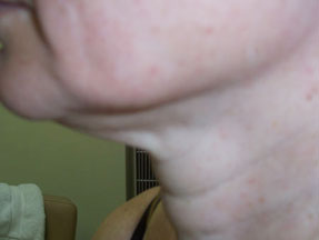 fillers, radiesse, juvederm, restylane before and after