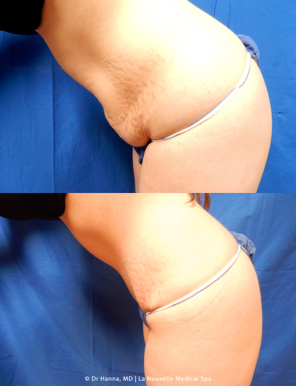 abdominoplasty tummy tuck  before after by dr antoine hanna la nouvelle medical spa ventura