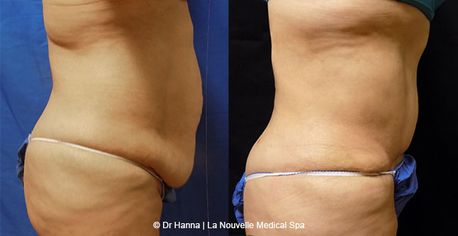 Tummy Tuck Ventura County, Abdominosplasty Before and After Photos by Dr. Hanna, La Nouvelle Medical Spa, Oxnard