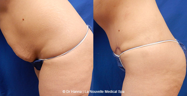 Tummy Tuck Ventura County, Abdominosplasty Before and After Photos by Dr. Hanna, La Nouvelle Medical Spa, Oxnard