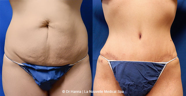 Tummy Tuck Ventura County, Abdominosplasty Before and After Photos by Dr. Hanna, La Nouvelle Medical Spa, Oxnard