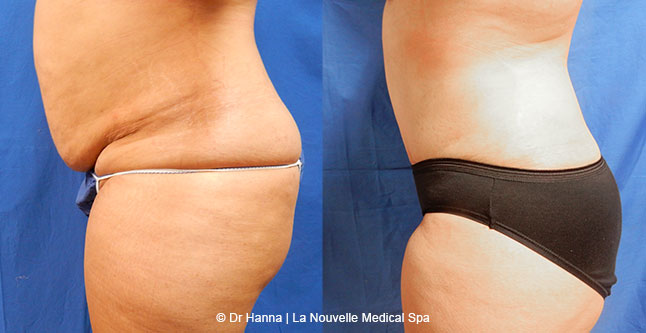 Tummy Tuck Ventura County, Abdominosplasty Before and After Photos by Dr. Hanna, La Nouvelle Medical Spa, Oxnard