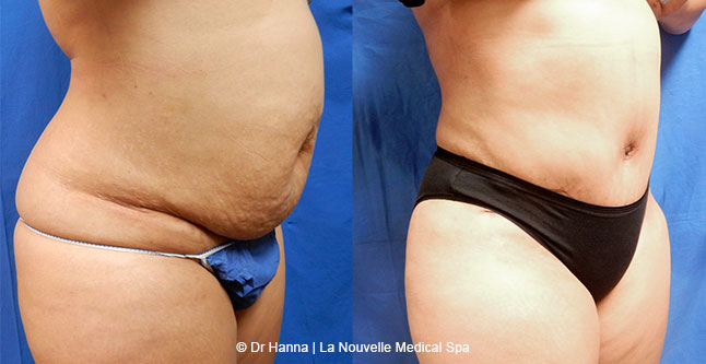 Tummy Tuck Ventura County, Abdominosplasty Before and After Photos by Dr. Hanna, La Nouvelle Medical Spa, Oxnard