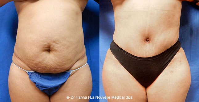 Tummy Tuck Ventura County, Abdominosplasty Before and After Photos by Dr. Hanna, La Nouvelle Medical Spa, Oxnard