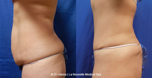 Tummy Tuck Ventura County, Abdominosplasty Before and After Photos by Dr. Hanna, La Nouvelle Medical Spa, Oxnard