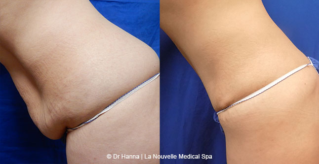 Tummy Tuck Ventura County, Abdominosplasty Before and After Photos by Dr. Hanna, La Nouvelle Medical Spa, Oxnard
