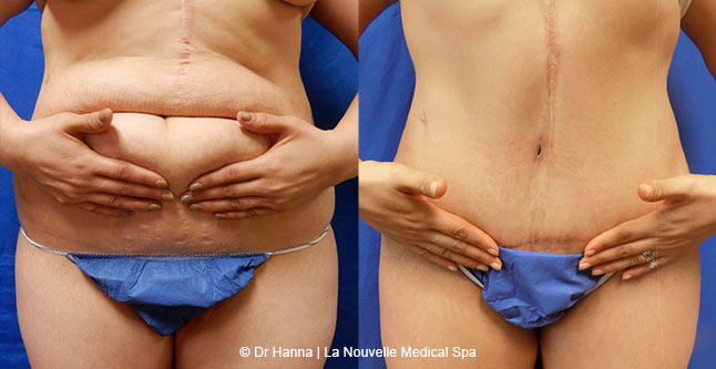 Tummy Tuck Ventura County, Abdominosplasty Before and After Photos by Dr. Hanna, La Nouvelle Medical Spa, Oxnard