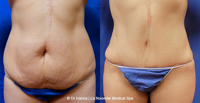 Tummy Tuck Ventura County, Abdominosplasty Before and After Photos by Dr. Hanna, La Nouvelle Medical Spa, Oxnard