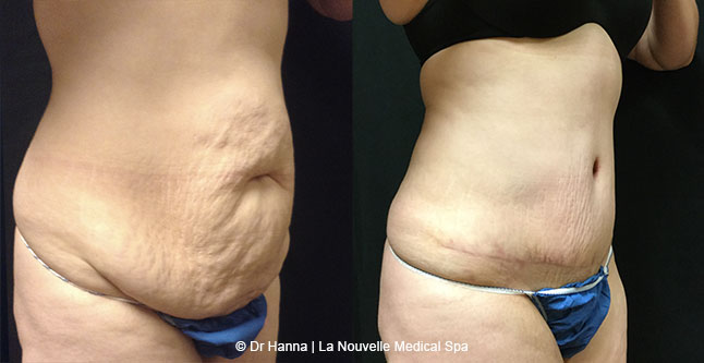 Tummy Tuck Ventura County, Abdominosplasty Before and After Photos by Dr. Hanna, La Nouvelle Medical Spa, Oxnard