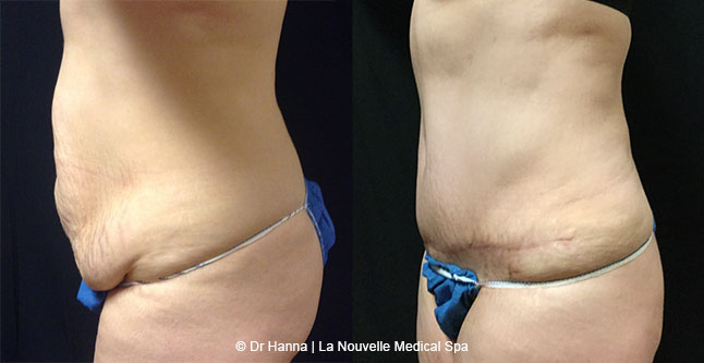 Tummy Tuck Ventura County, Abdominosplasty Before and After Photos by Dr. Hanna, La Nouvelle Medical Spa, Oxnard