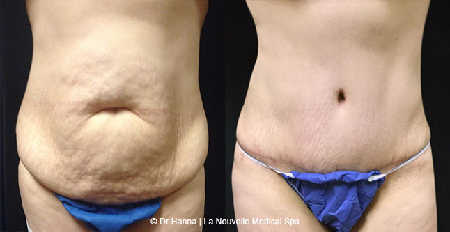 Tummy Tuck Ventura County, Abdominosplasty Before and After Photos by Dr. Hanna, La Nouvelle Medical Spa, Oxnard