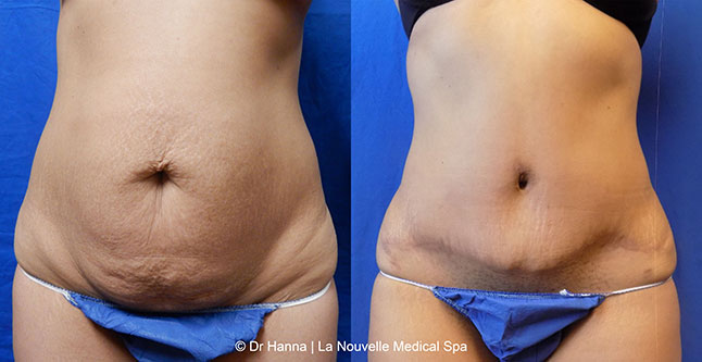 Tummy Tuck Ventura County, Abdominosplasty Before and After Photos by Dr. Hanna, La Nouvelle Medical Spa, Oxnard