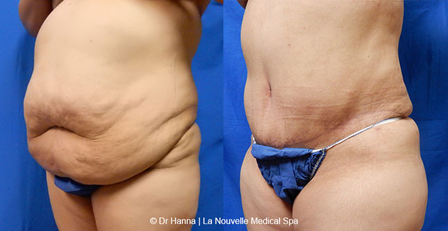 Tummy Tuck Ventura County, Abdominosplasty Before and After Photos by Dr. Hanna, La Nouvelle Medical Spa, Oxnard