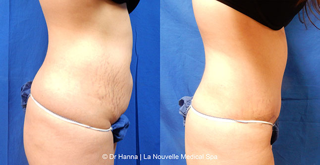 Tummy Tuck Ventura County, Abdominosplasty Before and After Photos by Dr. Hanna, La Nouvelle Medical Spa, Oxnard
