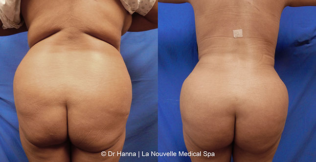 Tummy Tuck Ventura County, Abdominosplasty Before and After Photos by Dr. Hanna, La Nouvelle Medical Spa, Oxnard