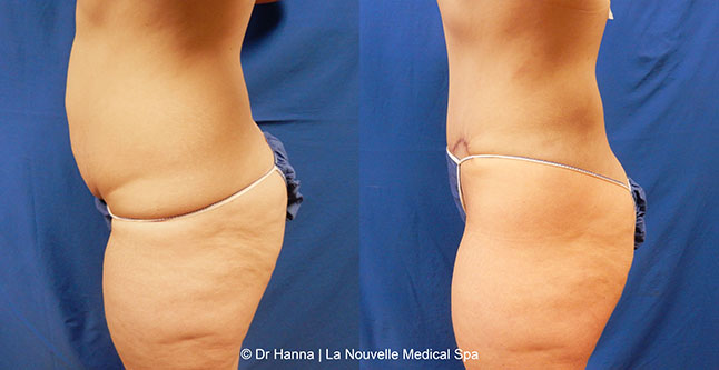 Tummy Tuck Ventura County, Abdominosplasty Before and After Photos by Dr. Hanna, La Nouvelle Medical Spa, Oxnard