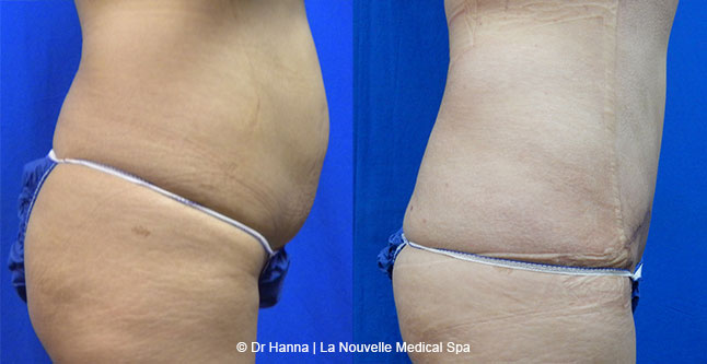 Tummy Tuck Ventura County, Abdominosplasty Before and After Photos by Dr. Hanna, La Nouvelle Medical Spa, Oxnard