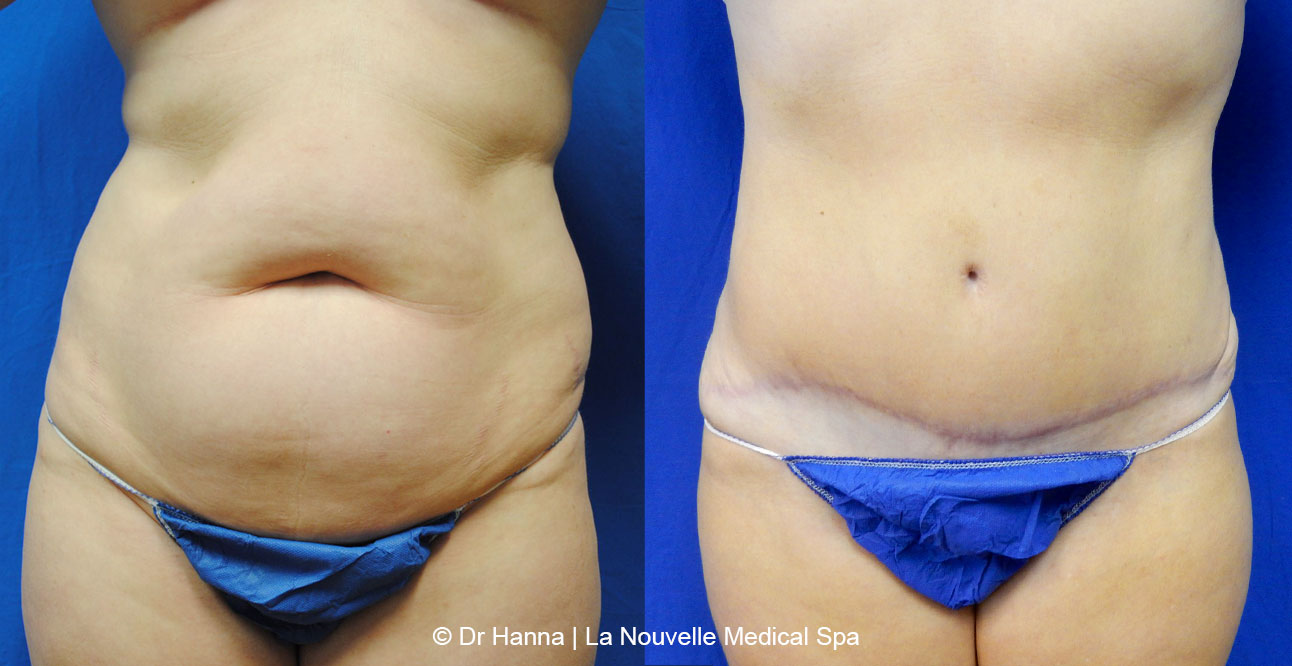 Tummy Tuck Ventura County, Abdominosplasty Before and After Photos by Dr. Hanna, La Nouvelle Medical Spa, Oxnard