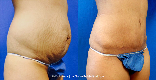 Tummy Tuck Ventura County, Abdominosplasty Before and After Photos by Dr. Hanna, La Nouvelle Medical Spa, Oxnard