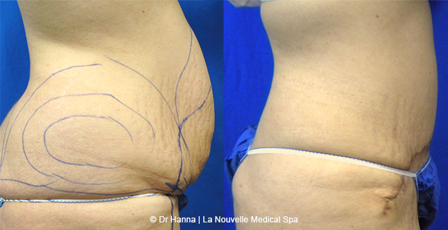 Tummy Tuck Ventura County, Abdominosplasty Before and After Photos by Dr. Hanna, La Nouvelle Medical Spa, Oxnard