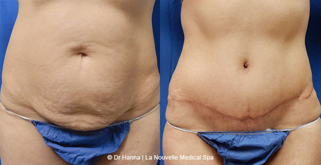 Tummy Tuck Ventura County, Abdominosplasty Before and After Photos by Dr. Hanna, La Nouvelle Medical Spa, Oxnard