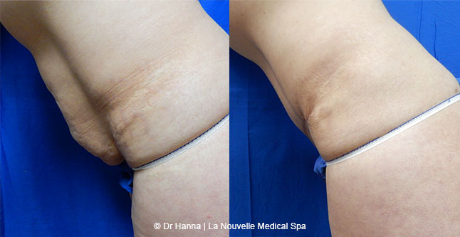 Tummy Tuck Ventura County, Abdominosplasty Before and After Photos by Dr. Hanna, La Nouvelle Medical Spa, Oxnard