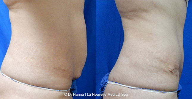 Tummy Tuck Ventura County, Abdominosplasty Before and After Photos by Dr. Hanna, La Nouvelle Medical Spa, Oxnard