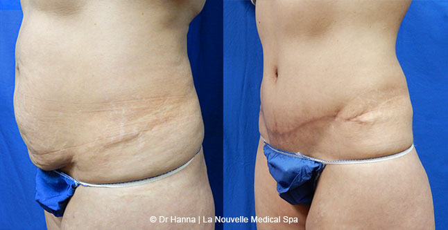 Tummy Tuck Ventura County, Abdominosplasty Before and After Photos by Dr. Hanna, La Nouvelle Medical Spa, Oxnard
